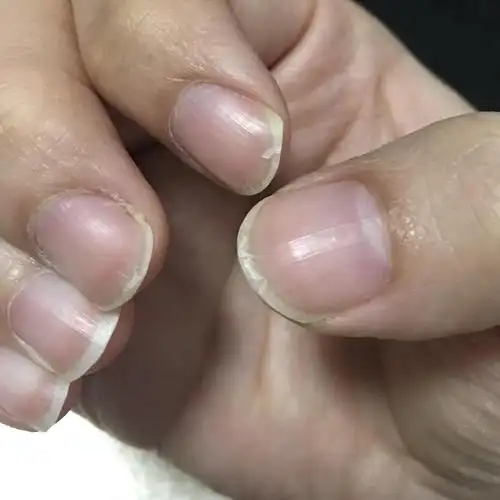 指甲一直在分层怎么办啊01