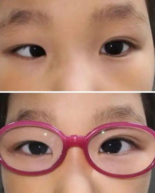 小儿斜视_治疗方式_日常注意事项 - 好大夫在线