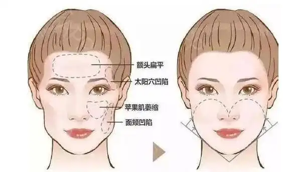 苹果肌到底是什么呢?