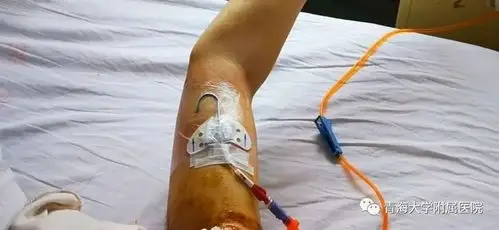 肿瘤患者picc置管后如何做好护理