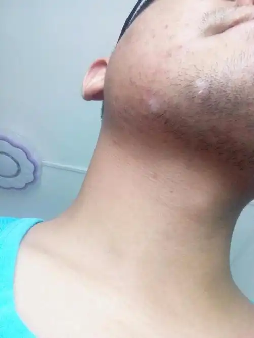 下巴处有两小块白斑,胡子长出来也是白的,有人知道这是什么情况吗?