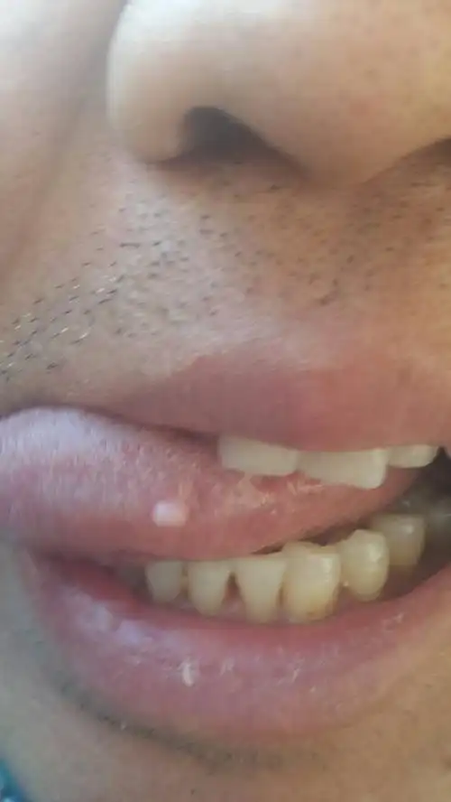 舌头上长了个白色的疙瘩,不疼不痒,可能是什么问题?