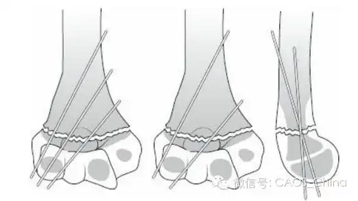 儿童肱骨髁上骨折的治疗