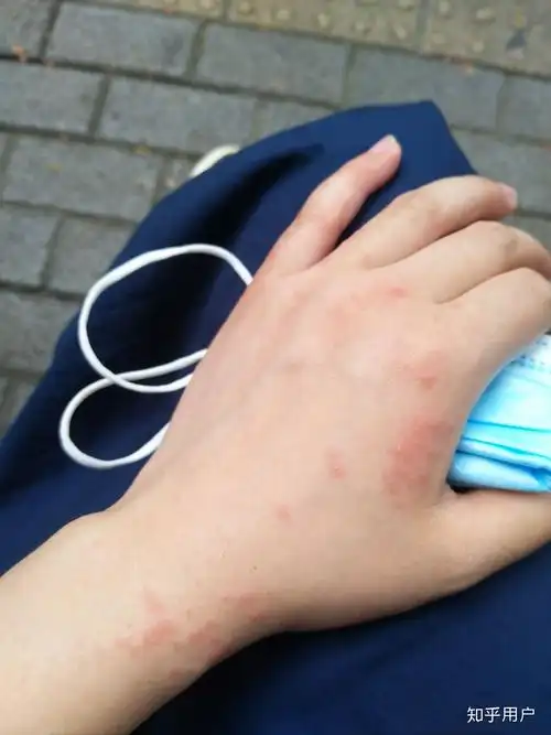 臭虫咬过的疙瘩什么样? - 知乎