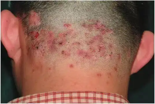 头皮毛囊炎是指仅累及头部毛囊及其周围组织的细菌感染性皮肤病.