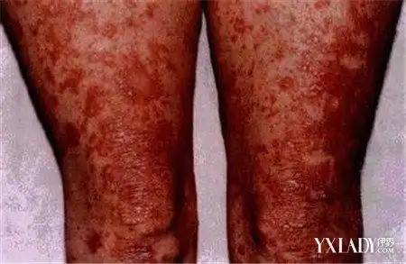 身上出现红色斑块很痒是怎么回事7个因素告诉你