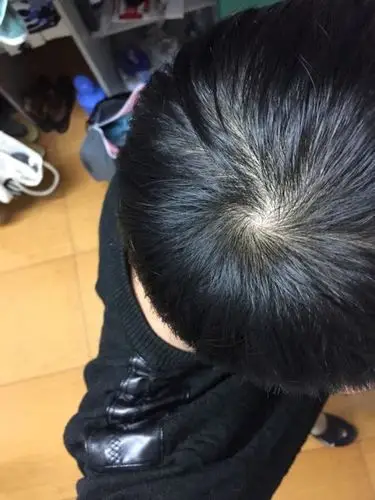 之前也没仔细观察过自己头顶,但是入秋之后感觉到头发掉了所以有点