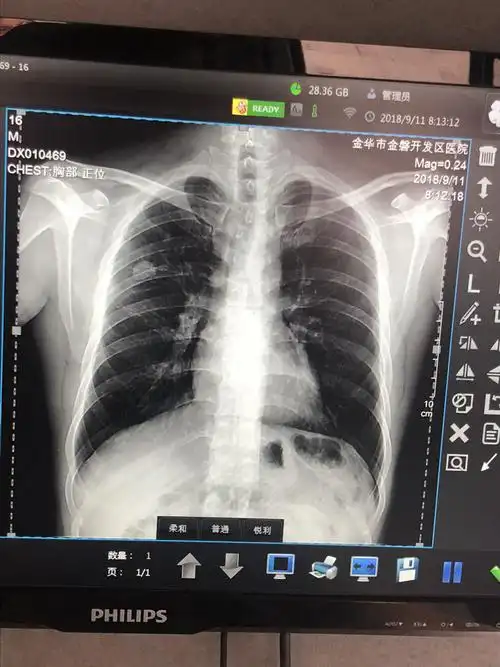 今天公司体检,dr摄影肺上部有个圆圈阴影,请教专家或医术精湛的师傅