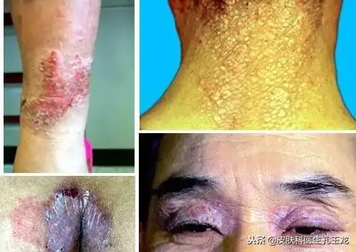 因为神经性皮炎有一个"瘙痒——搔抓——瘙痒"的恶性循环,往往越抓越