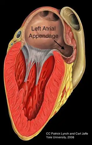 left atrial appendage thrombus