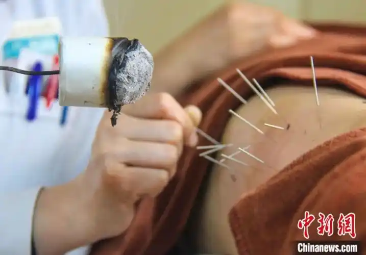 河南省南阳市中医院医师在给患者进行腿部传统针灸治疗.