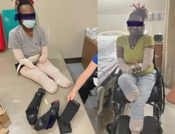 美32岁三宝妈染疫血栓"惨被截去四肢",她po照呼吁:快去打疫苗|截肢