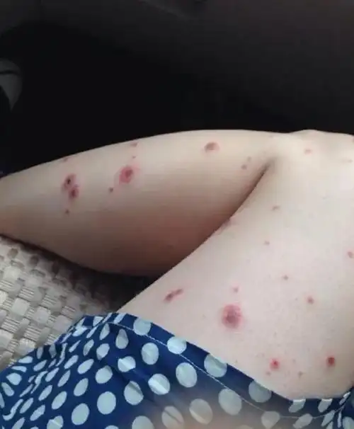 生活日记湿疹的修复