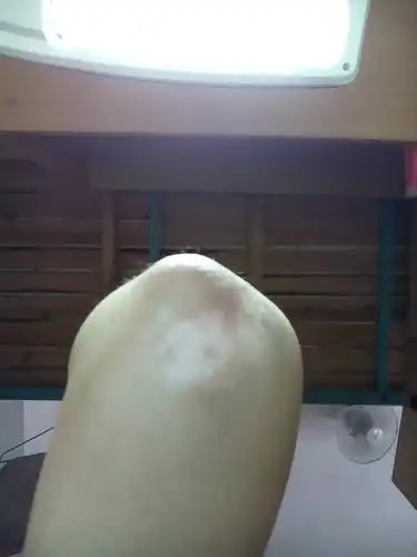 手肘突然这样了,有人知道怎么回事,怎么解决吗?谢谢啦