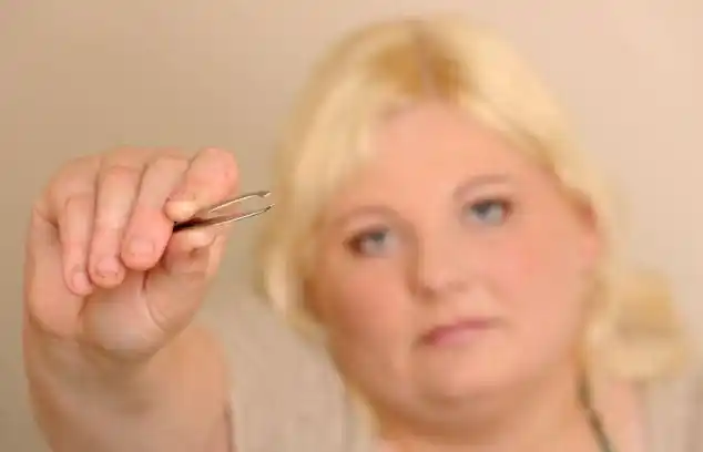 英女子患罕见病拔汗毛成瘾组图