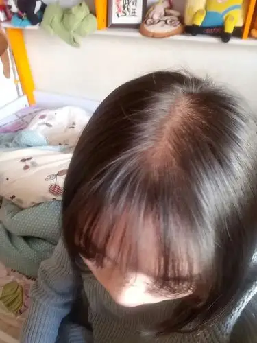 本人女 22岁 头发细软 头顶脱发看得到头皮怎么办?