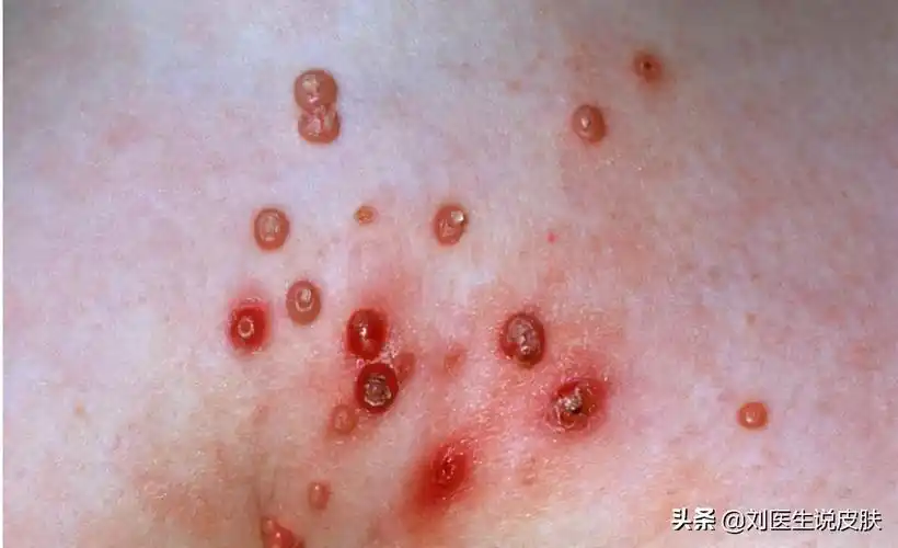 丝状疣是怎么引起的(皮肤长小肉疙瘩)-第2张图片-51乐学网