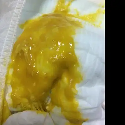 有图慎入…宝宝大便稀水样,黄色,有絮状物和黏液是怎麼回事?急!