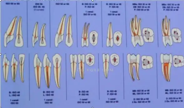 根管治疗成功的保障--赵廷旺