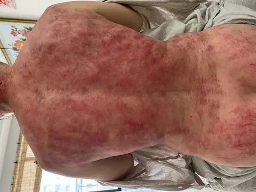 其它 问世间"痧"为何物 写美篇大红色痧 刮痧可把 带状疱疹消灭于萌芽