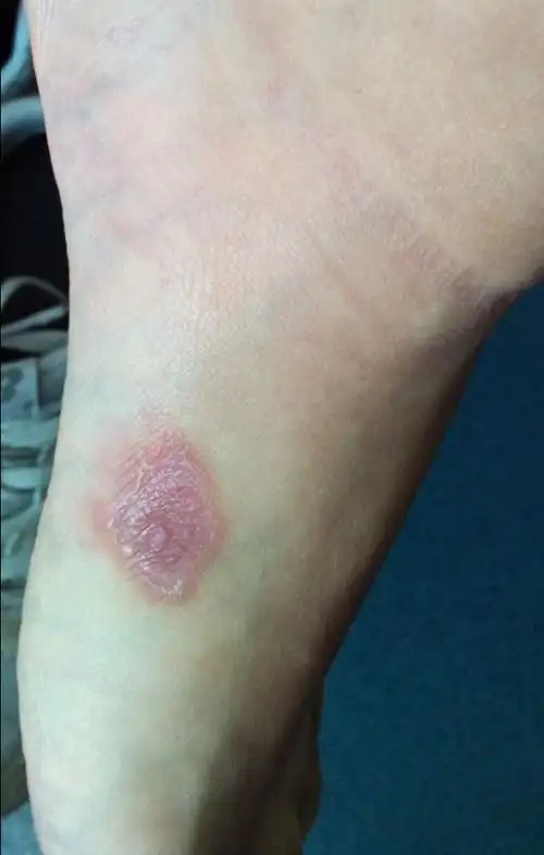 不痛不痒的皮疹不要自行处理,有可能是梅毒