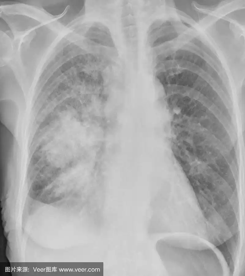 女性吸烟者的数码胸部x光片显示肺癌