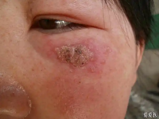 孢子丝菌病一例 - 皮肤及性传播疾病讨论版 - 爱爱医医学论坛