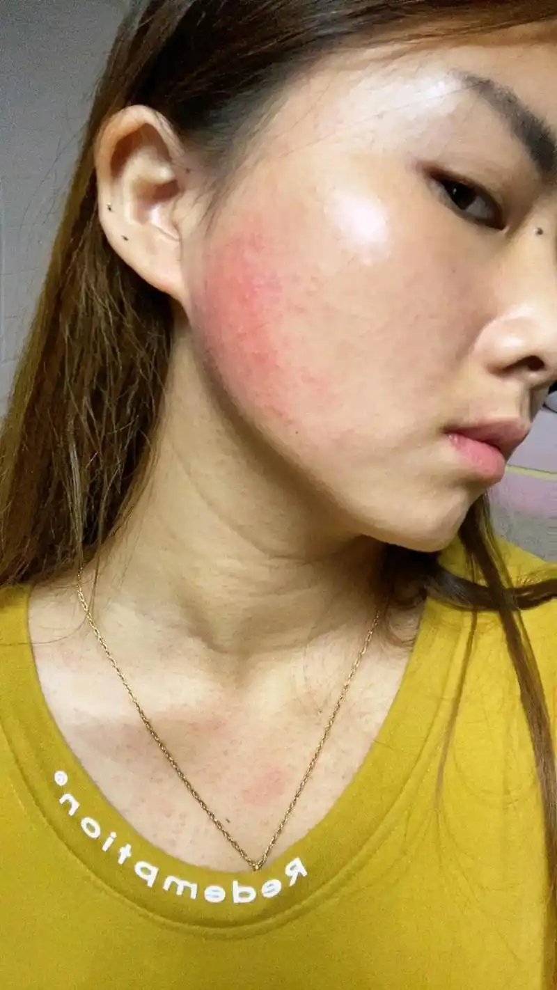 脸上和脖子上一下子长了很多密密麻麻的小 - 抖音