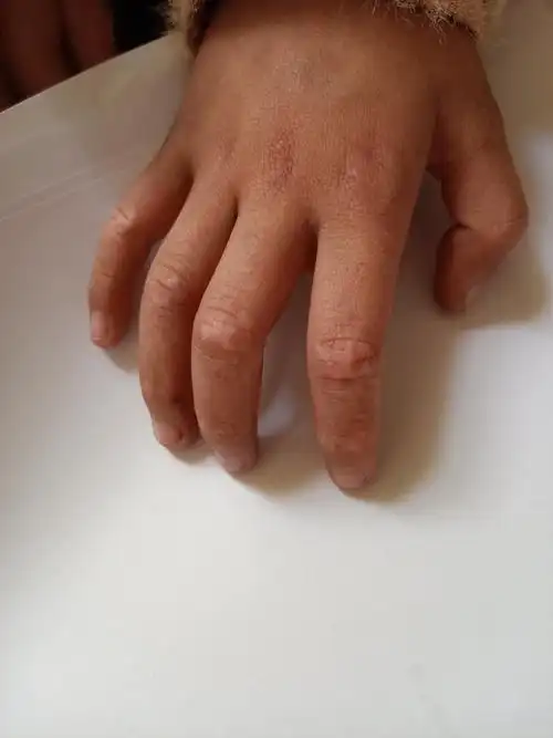 五岁小朋友手指背侧色素脱失