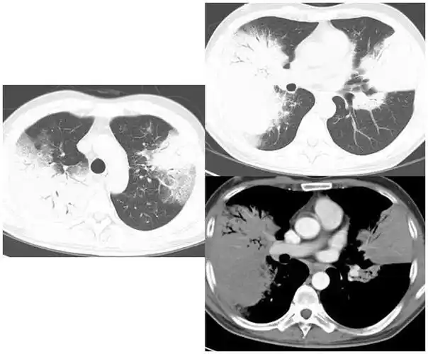 慧读片(6)丨从病例了解「百变机化性肺炎」的典型与非典型征象