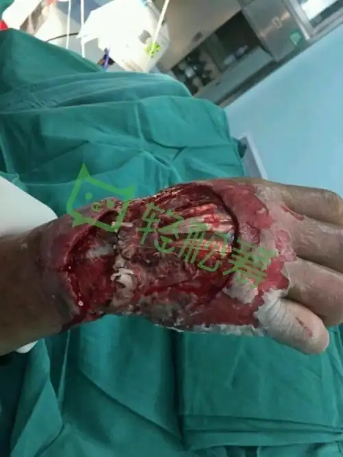 心脏搭桥手术伤口图片