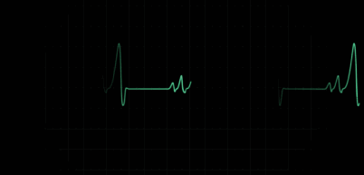 心电监护仪波纹一会儿成直线(心脏停搏),一会儿波纹又起(心脏跳动)