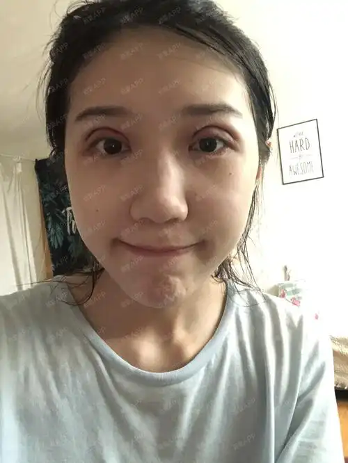 新氧小白前来报到了哦,只是才做完双眼皮第二天的样子_圈子-新氧美容