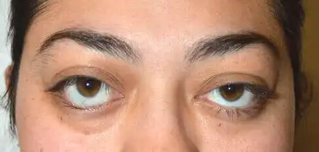 立即咨询那么"下三白"的眼睛有没有方法改善呢?