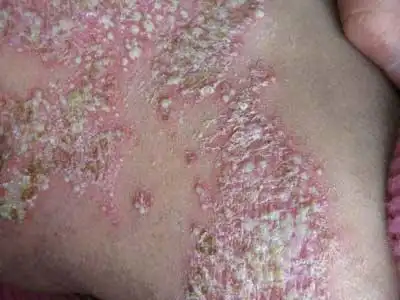 地图状银宵病晚期症状