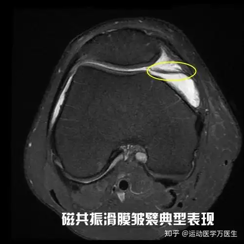 膝关节里那磨人的小妖精滑膜皱襞plica综合症