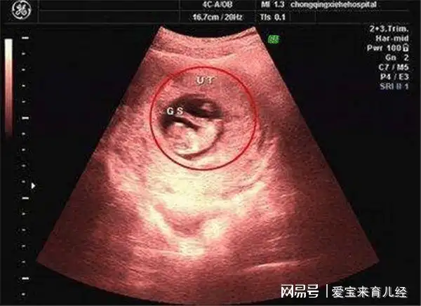只看到了孕囊,并没有看到胎心胎芽等,先不要太过惊慌,也有可能是怀孕