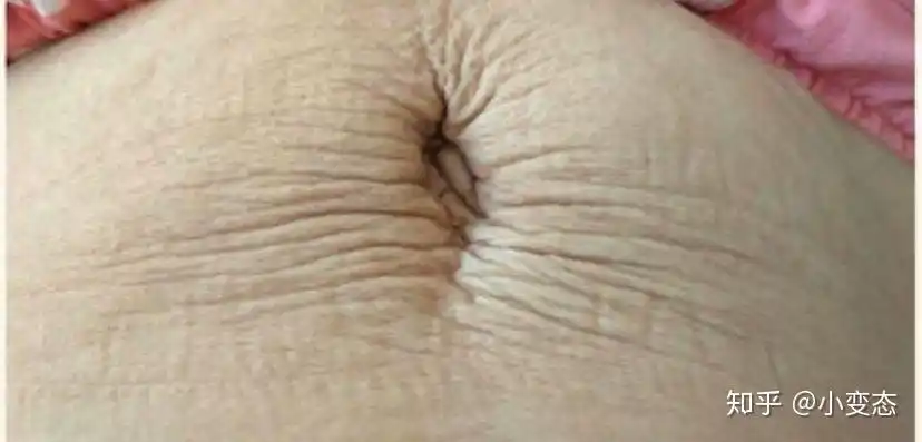 们(尤其是大龄产妇)生产后腰腹部的皮肤失去往日的张力会变得十分松弛