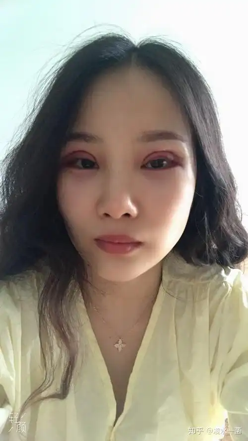 武汉肿眼泡做双眼皮全切手术分享