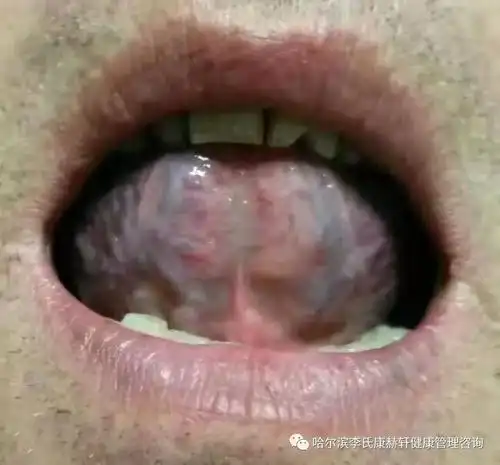 6.舌下青筋凸起,相应于人心脏的冠状动脉,容易引起心脏疾病,心肌劳损.