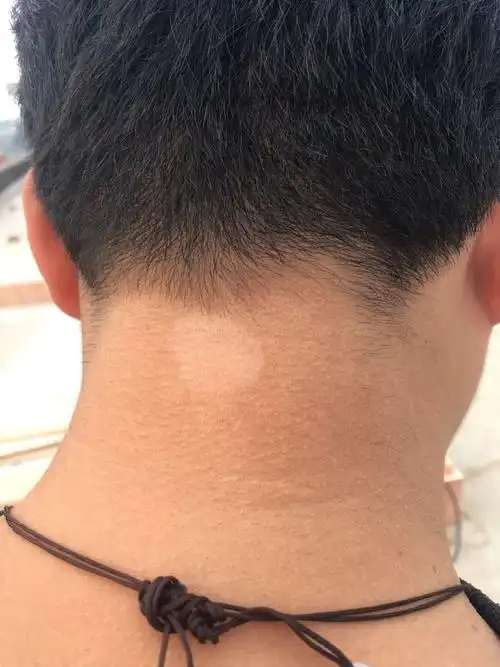 脖子后面起了个白斑,没有感觉,是白癜风吗?