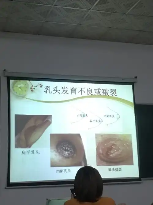 母婴护理～疾病护理～乳头皲裂～挤奶～退奶