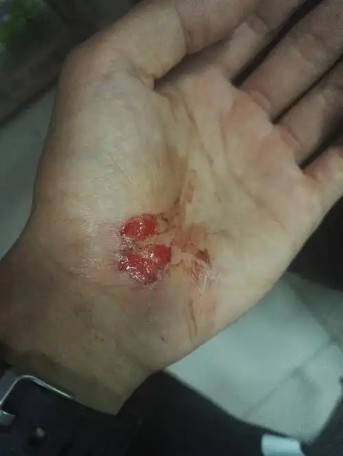 请问手上骑车摔了一下,大概几天好?谢谢.