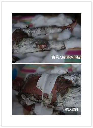 写美篇    患者王先生,38岁,因煤气爆燃致全身95%烧伤,于某三甲医院