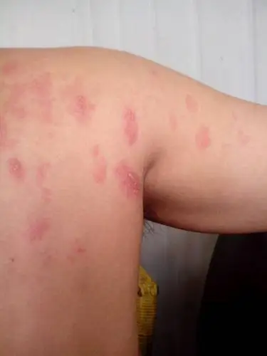 毒疮图片 (20)_有来医生