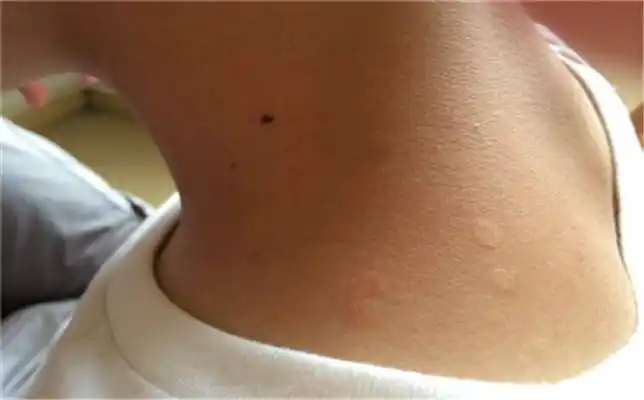 重庆花斑癣医院_重庆治疗花斑癣哪家医院好_重庆治疗花斑癣权威的医院