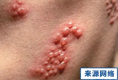 艾滋病皮疹图片 背部斑丘疹