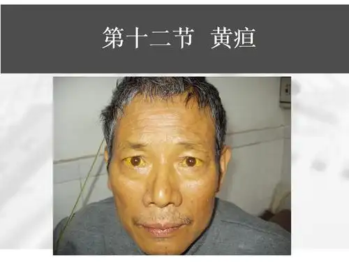 临床医学概论常见症状第二章黄疸血尿ppt37页