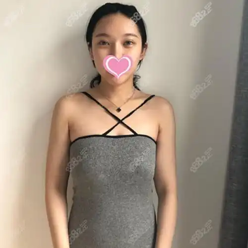 深圳阳光罗志敏隆胸手术真人效果证实他做胸的技术也不差