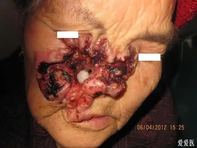 病例分享--------------------吓人是基底细胞癌(胆小者别看) - 皮肤